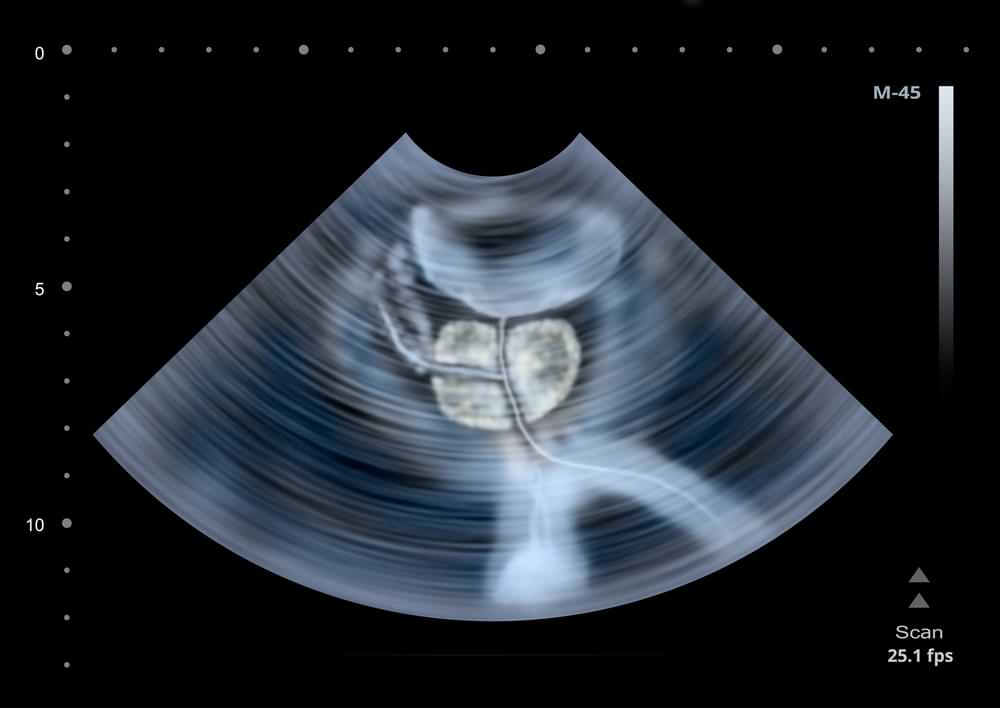 Snimak ultrazvučnog pregleda prostate